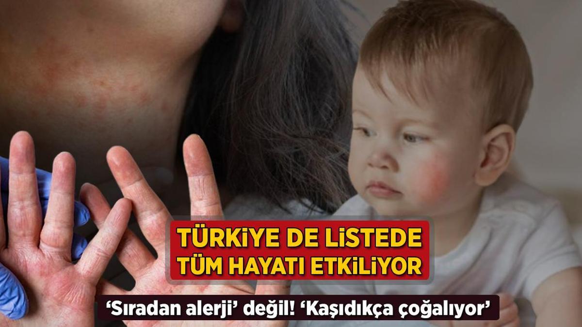 turkiye de listede tum hayati kotu etkiliyor siradan alerji degil kasidikca cogalir 5h8eg8cn.jpg